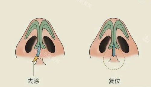 鼻子假体歪斜复位示意图 鼻子假体歪斜复位示意图