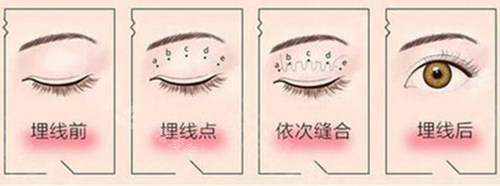 埋线双眼皮过程示意图片
