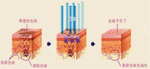兰州时光激光整形医院祛斑怎么样？色斑淡化明显，但疗程要看个人！