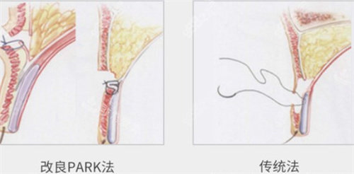 park雙眼皮和傳統(tǒng)對比