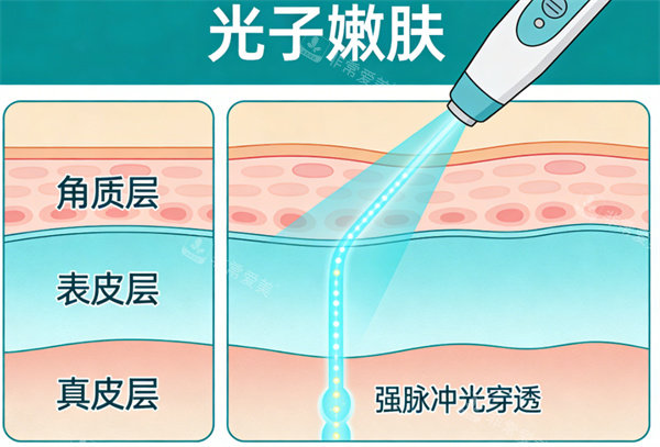 光子嫩膚操作卡通示意圖