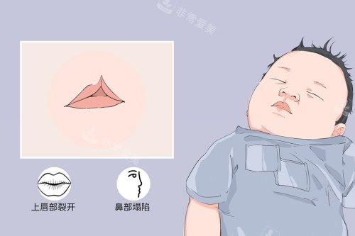 唇腭裂症状图