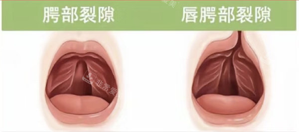唇腭裂