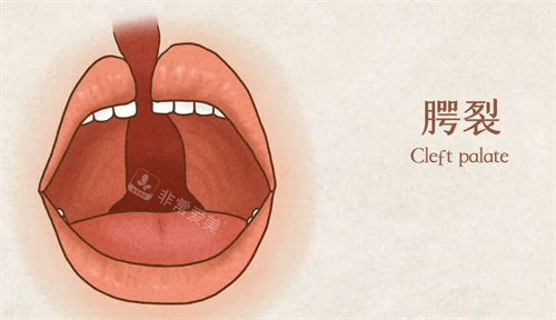 唇腭裂口内的动画展示