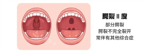 二度唇腭裂示意图