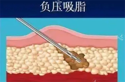 成都华人医联吸脂多少钱？双下巴下颌缘加副乳脂雕光雕套餐12800元全解析~