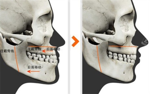 双鄂手术对比图 双鄂手术对比图
