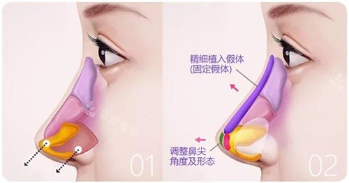 成都西区整形医院做鼻子怎么样？鼻修复技术稳！段焘、邓东伟双咖操刀自然妈生鼻！