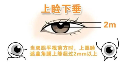 韩国上睑下垂矫正医院排名大众汇总：mulyonlyeyeEveBIO大眼睛美lineLuho汝好整形外科人气高