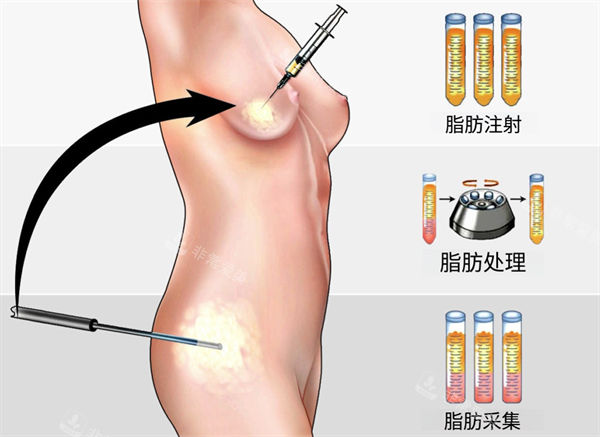 自体脂肪隆胸示意图