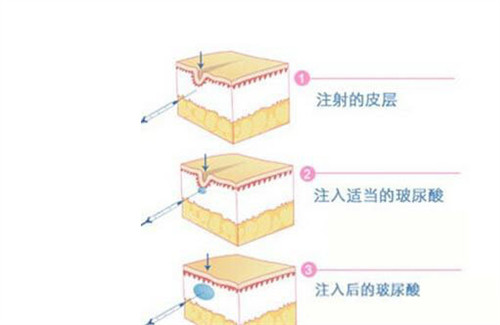 2026赴韩医美必看：新论岘Toxnfill玻尿酸丰唇垫下巴多少钱？纯干货预约流程！
