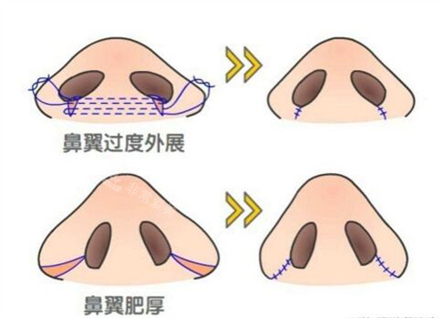 成都鼻翼缩小手术大概费用是多少钱？成都本地收费区间大公开大概起步价格是6500元起！