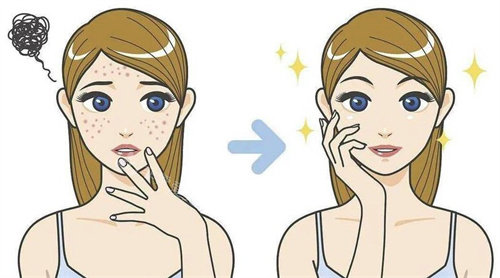 去痘印卡通图 去痘印卡通图