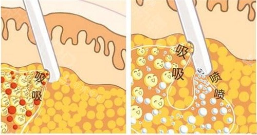 网友热荐！韩国抽脂手术表现出色的十大整形医院排名表，为你揭秘靠谱变漂亮之选！