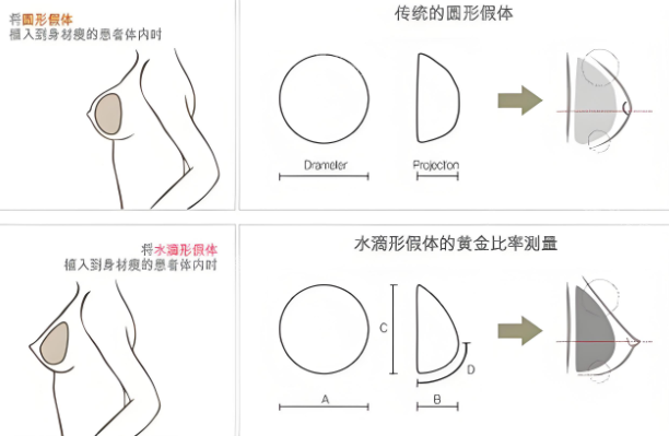 隆胸假体形状对比 隆胸假体形状对比