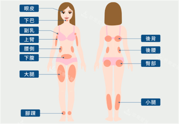 常见吸脂部位