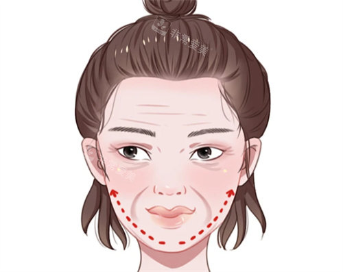 面部抗衰提升卡通图