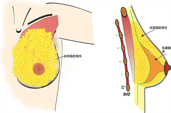自体脂肪填充隆胸内部图