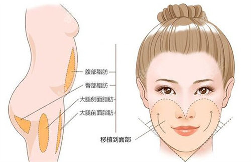 面部脂肪填充卡通图