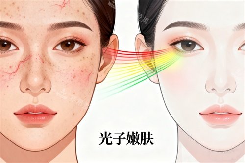 脸部做光子嫩肤前后对比