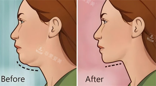 热拉提前后对比 热拉提前后对比