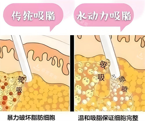 威塑吸脂和水动力吸脂哪个好？想雕马甲线还是全身瘦？看完这篇你就不纠结了！