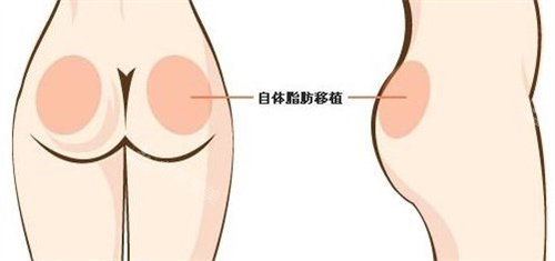 自体脂肪丰臀 自体脂肪丰臀
