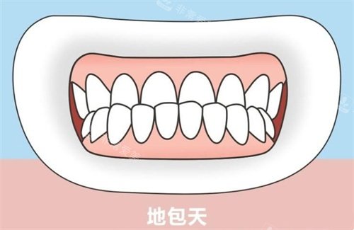 地包天示意图