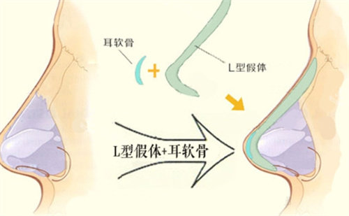 北京柏丽医疗美容地址：西四环中路39号，地铁1号线直达，网友分享鼻部整形结果自然！速来围观！