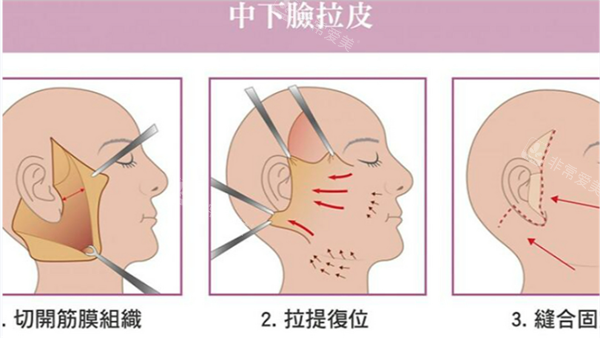 面部拉皮手术 面部拉皮手术