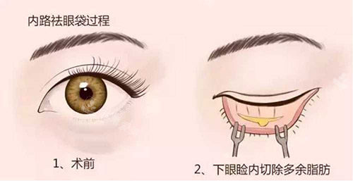 去眼袋手术 去眼袋手术