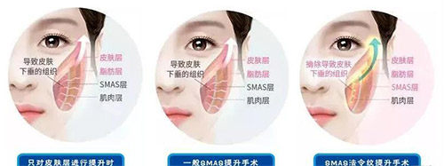 三类拉皮手术方法对比 三类拉皮手术方法对比