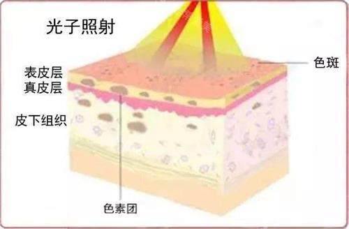 光子嫩肤的示意图.