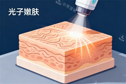 皮肤做光子嫩肤卡通图