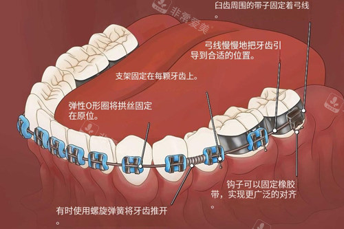 金属牙齿矫正器功能示意图 金属牙齿矫正器功能示意图