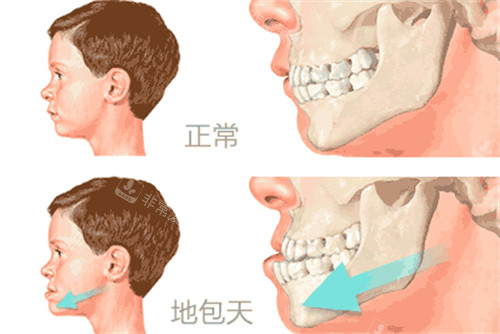 地包天与正常咬合对比动画图 地包天与正常咬合对比动画图