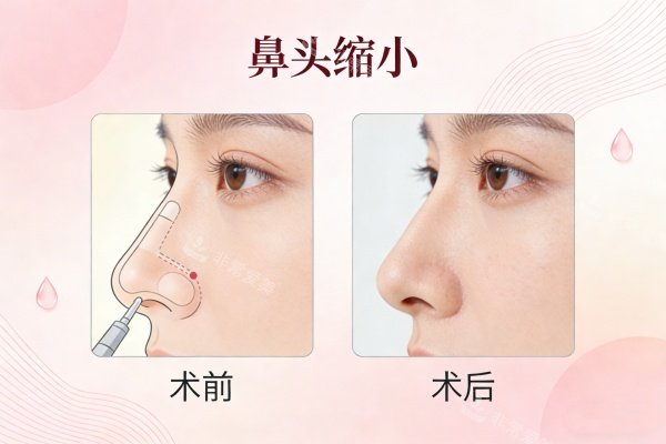 乌鲁木齐缩鼻头价格大公开！华美整形费用明细+结果实测，速戳！