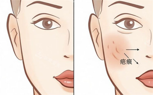 祛疤前后对比卡通图.jpg 祛疤前后对比卡通图.jpg