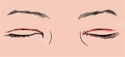 双眼皮疤痕修复.jpg 双眼皮疤痕修复.jpg