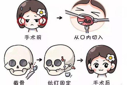 颧骨整形手术卡通形象图 颧骨整形手术卡通形象图