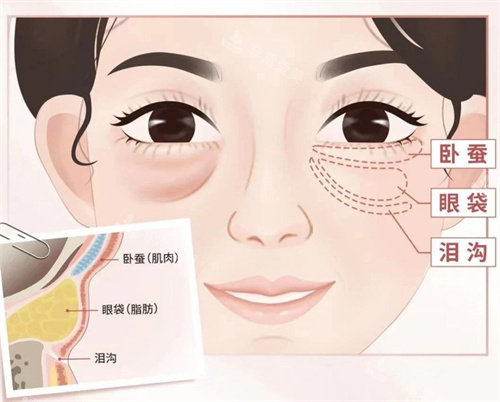 眼袋图片展示