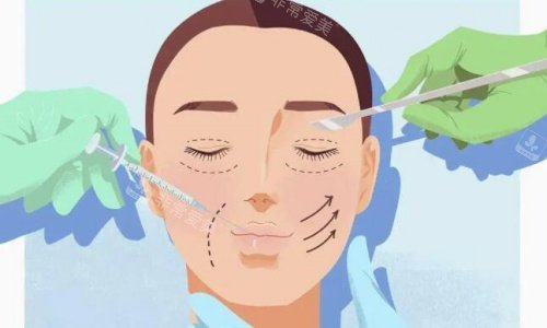 双眼皮手术操作示意图
