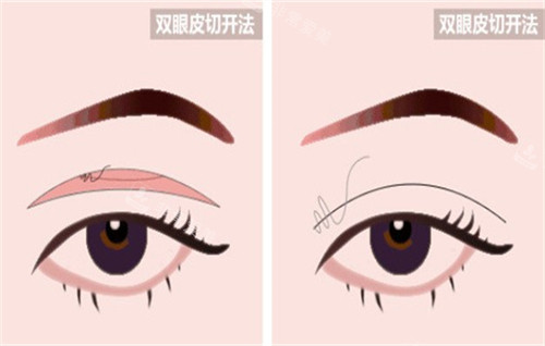 全切双眼皮手术的切口部位.jpg