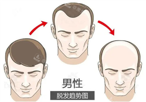 脱发趋势图 脱发趋势图