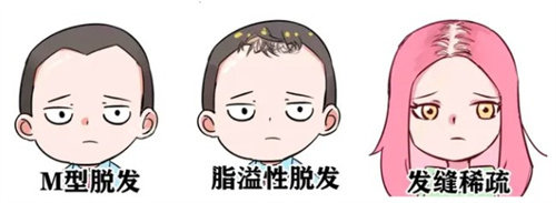 脱发种类 脱发种类