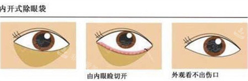 内切法祛眼袋手术过程.jpg