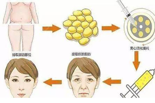 面部脂肪填充过程示意图.jpg