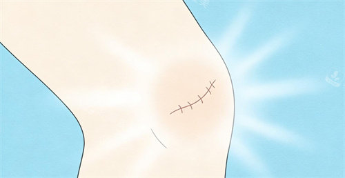 疤痕修复卡通展示照片 疤痕修复卡通展示照片