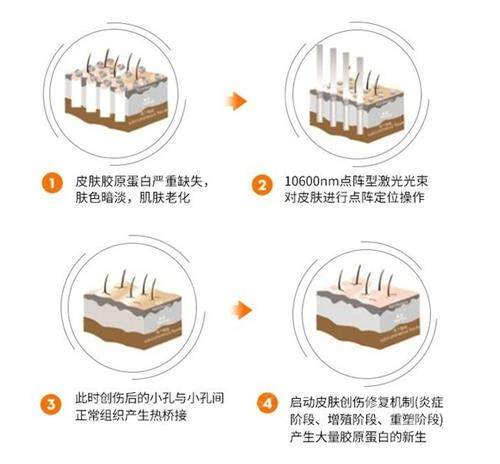 点阵激光的治疗步骤.png