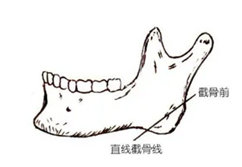 下颌角截骨简笔.jpg